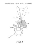 Surgical instrument for operations on the spinal column diagram and image