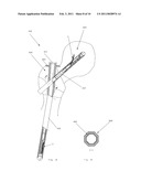 DEVICE FOR REDUCING A BONE FRACTURE diagram and image