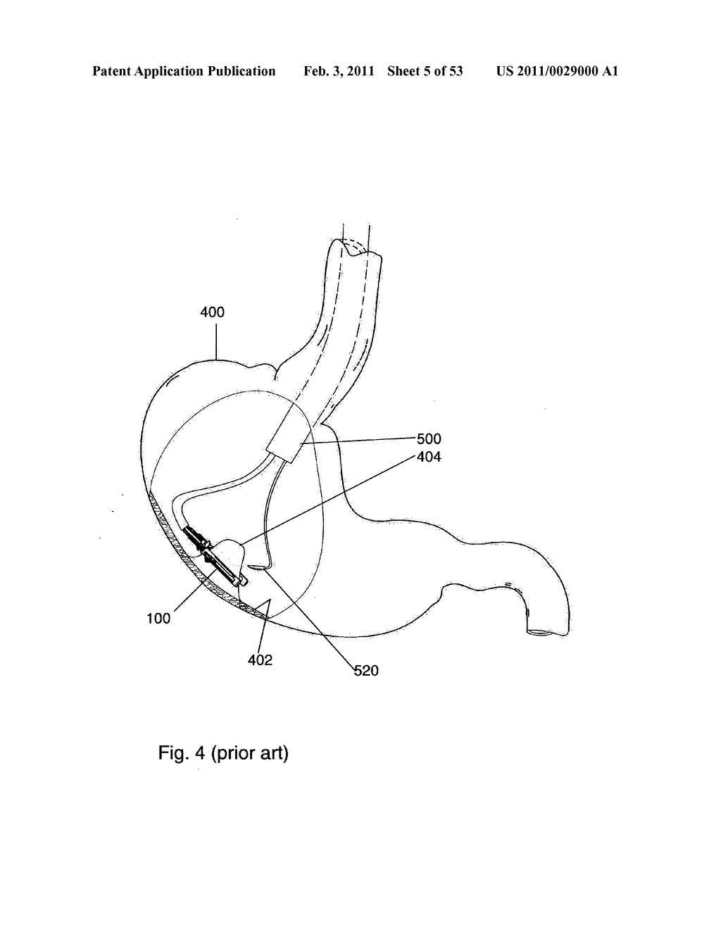 IN VIVO SUTURE ASSEMBLIES - diagram, schematic, and image 06