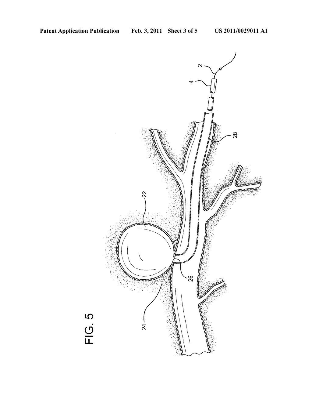 Clotting method for the repair of vascular defects and malformations - diagram, schematic, and image 04