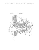 BIMODAL HEARING PROSTHESIS diagram and image