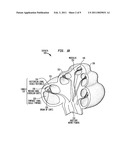 BIMODAL HEARING PROSTHESIS diagram and image