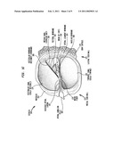 BIMODAL HEARING PROSTHESIS diagram and image