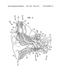 BIMODAL HEARING PROSTHESIS diagram and image