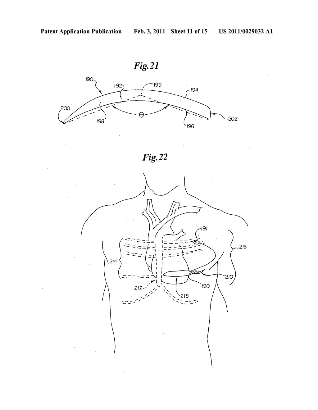 Cardioverter-Defibrillator Having a Focused Shocking Area and Orientation Thereof - diagram, schematic, and image 12