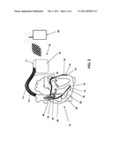 VENTRICULAR CARDIAC STIMULATOR diagram and image