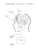 Intracranial Electrical Seizure Therapy (ICEST) diagram and image