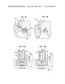 HEARING PROSTHESIS WITH AN IMPLANTABLE MICROPHONE SYSTEM diagram and image