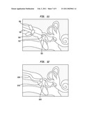 HEARING PROSTHESIS WITH AN IMPLANTABLE MICROPHONE SYSTEM diagram and image