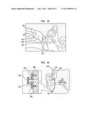 HEARING PROSTHESIS WITH AN IMPLANTABLE MICROPHONE SYSTEM diagram and image