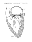 Heart valve prosthesis and method of implantation thereof diagram and image