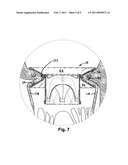 Heart valve prosthesis and method of implantation thereof diagram and image