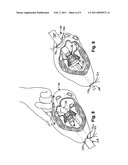 Heart valve prosthesis and method of implantation thereof diagram and image