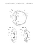 FIXATION OF OPHTHALMIC IMPLANTS diagram and image