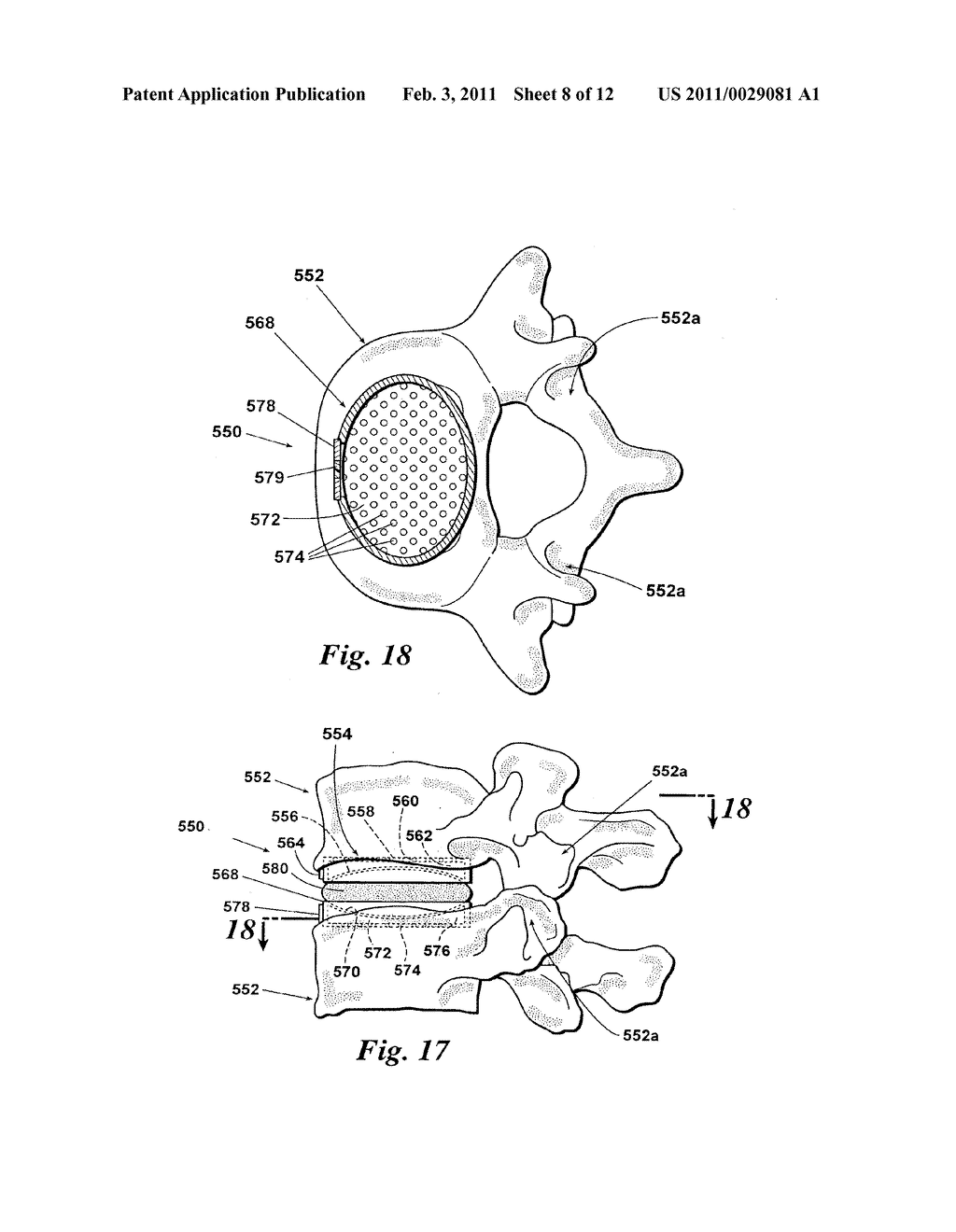 DEVICES AND METHODS FOR FACILITATING CONTROLLED BONE GROWTH OR REPAIR - diagram, schematic, and image 09