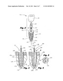 DENTAL IMPLANT diagram and image