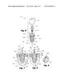 DENTAL IMPLANT diagram and image