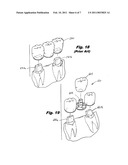 DENTAL IMPLANT diagram and image