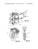 DENTAL IMPLANT diagram and image