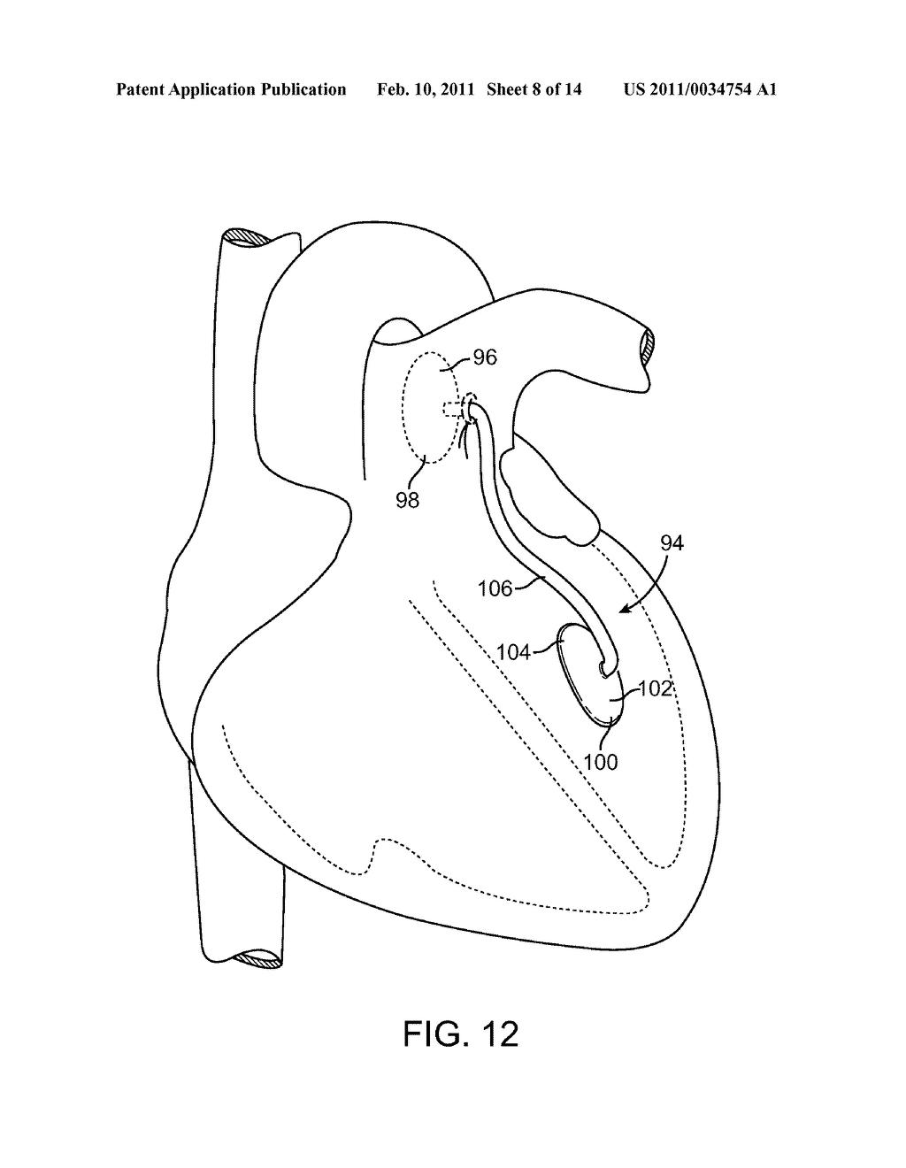 DEVICES AND METHODS FOR ABSORBING, TRANSFERRING AND DELIVERING HEART ENERGY - diagram, schematic, and image 09