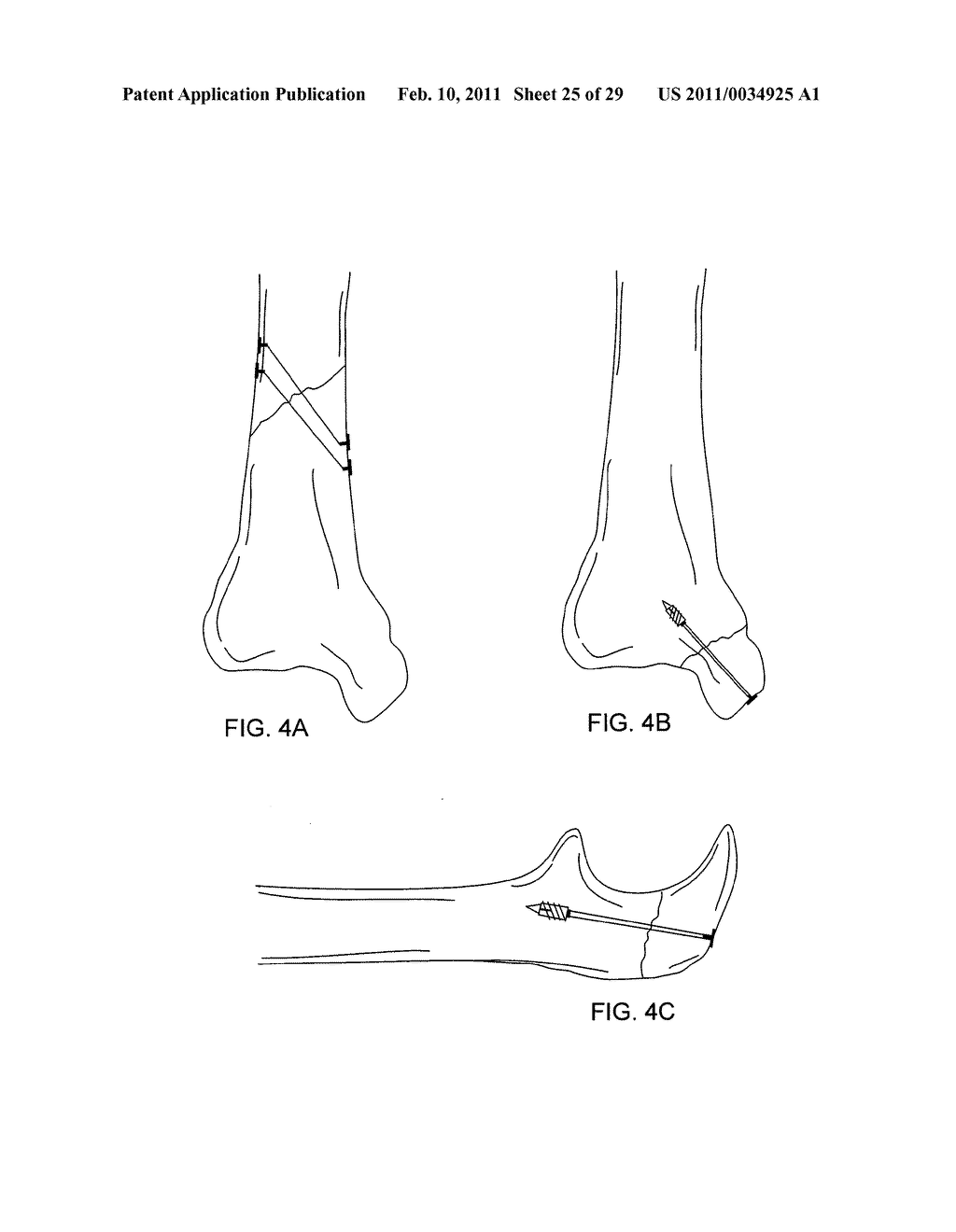 LAGWIRE SYSTEM AND METHOD FOR THE FIXATION OF BONE FRACTURES - diagram, schematic, and image 26