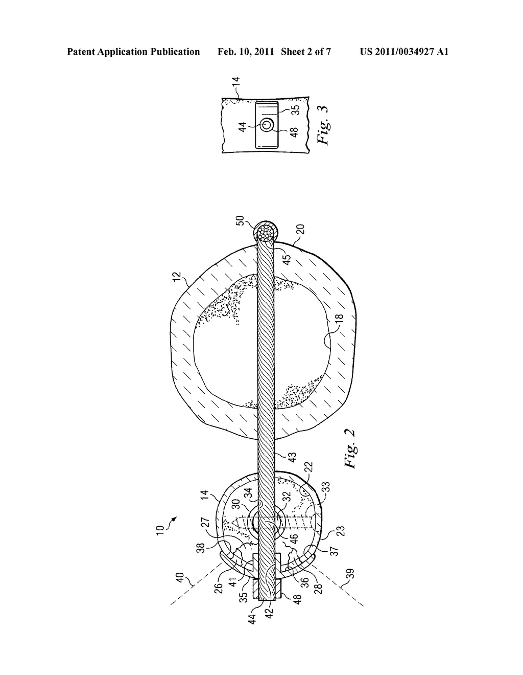 Bone Fixation System and Method of Use - diagram, schematic, and image 03