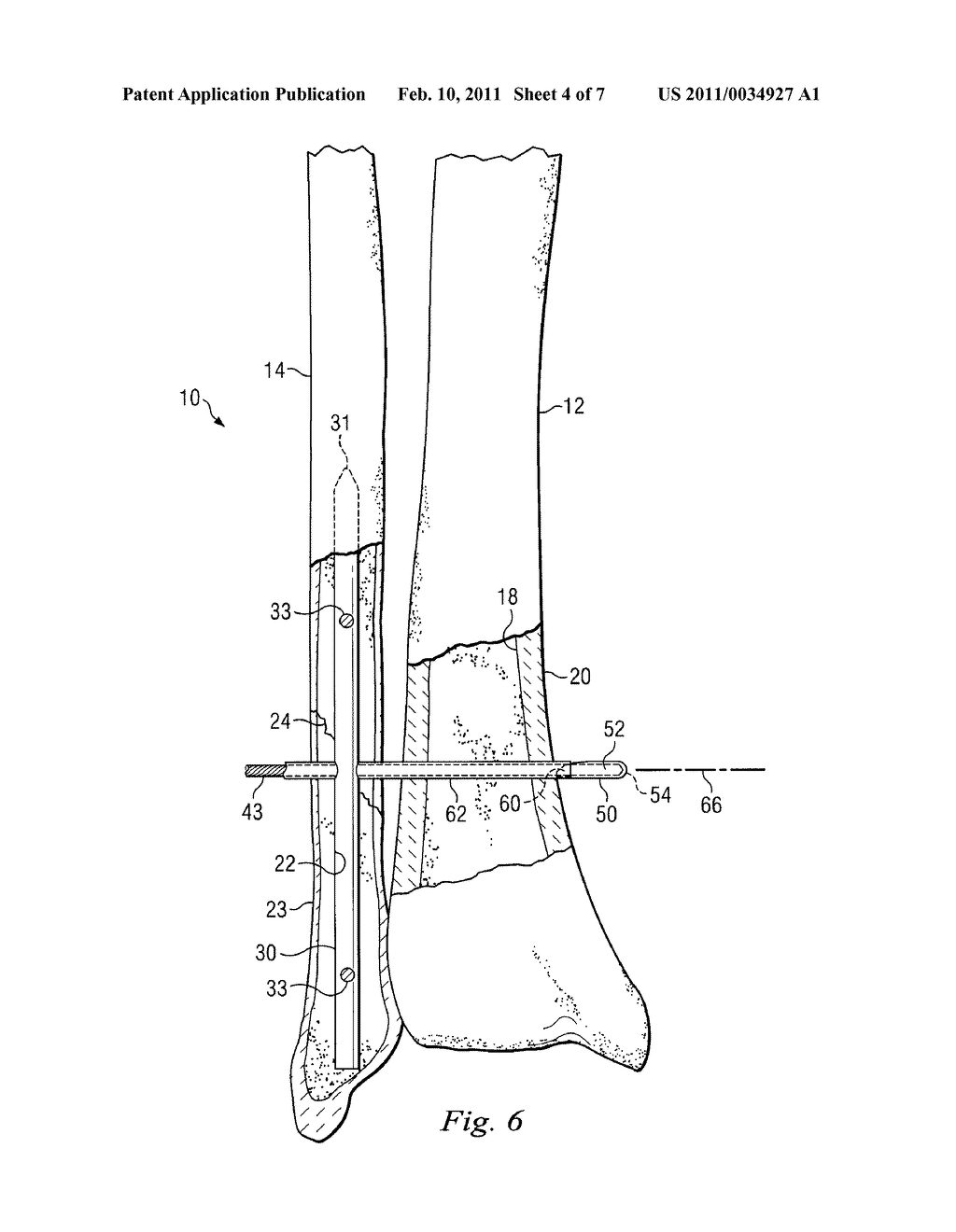 Bone Fixation System and Method of Use - diagram, schematic, and image 05