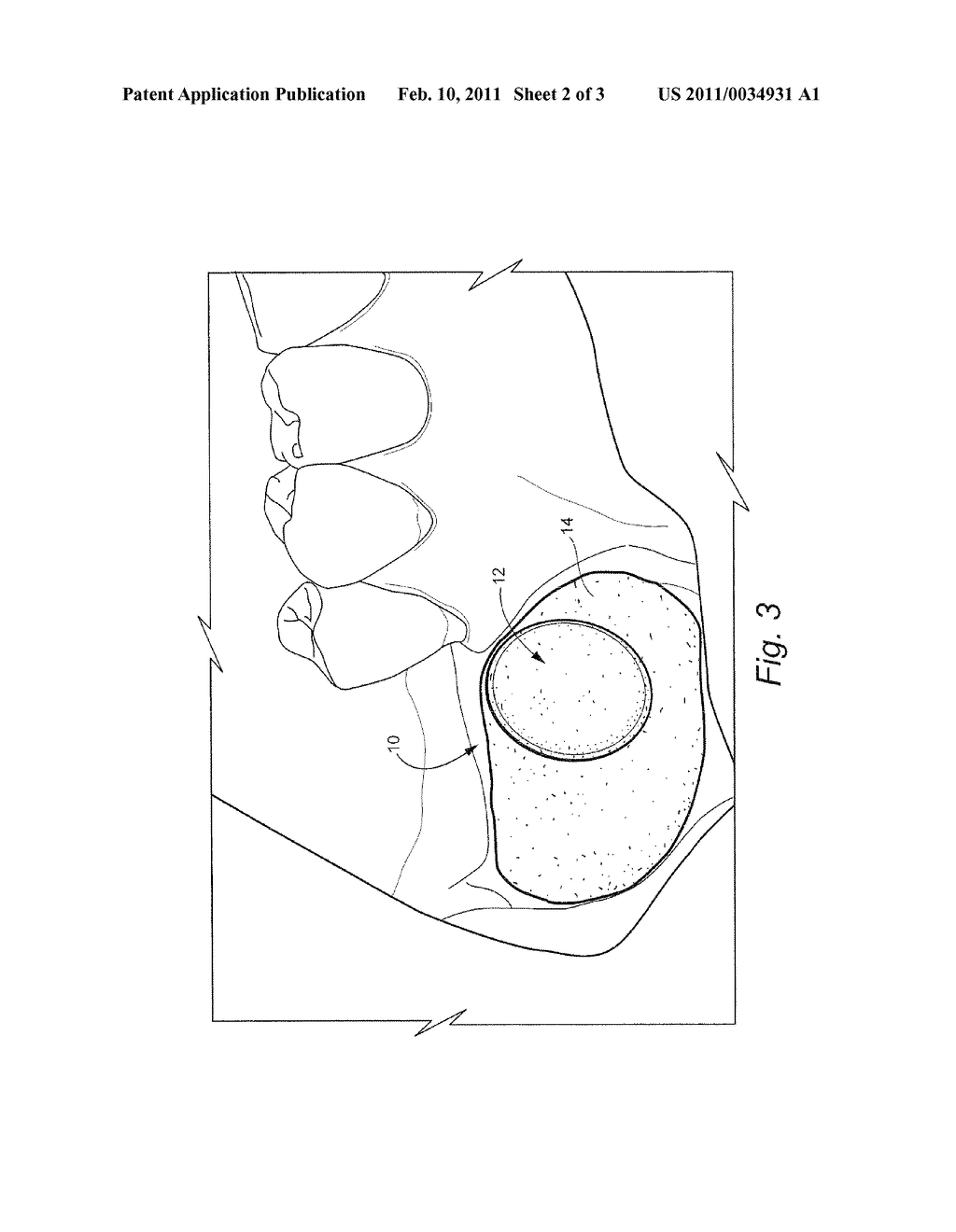 METHOD FOR PREPARING RECIPIENT SITE AND IMPLANTING ALLOGENIC BONE GRAFT - diagram, schematic, and image 03