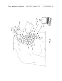 DELIVERY OF CARDIAC STIMULATION DEVICES diagram and image