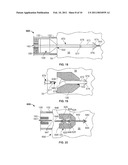 DELIVERY OF CARDIAC STIMULATION DEVICES diagram and image