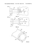 DELIVERY OF CARDIAC STIMULATION DEVICES diagram and image