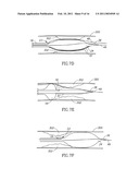 SYSTEMS AND METHODS FOR TREATING A VESSEL USING FOCUSED FORCE diagram and image