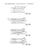 SYSTEMS AND METHODS FOR TREATING A VESSEL USING FOCUSED FORCE diagram and image