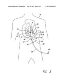 SUTURELESS REINFORCEMENT FOR AND METHOD OF TREATING A MYOCARDIAL INFARCTION diagram and image