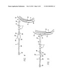 SUTURELESS REINFORCEMENT FOR AND METHOD OF TREATING A MYOCARDIAL INFARCTION diagram and image