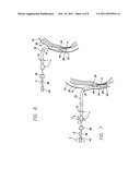 SUTURELESS REINFORCEMENT FOR AND METHOD OF TREATING A MYOCARDIAL INFARCTION diagram and image