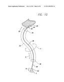 SUTURELESS REINFORCEMENT FOR AND METHOD OF TREATING A MYOCARDIAL INFARCTION diagram and image