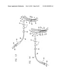 SUTURELESS REINFORCEMENT FOR AND METHOD OF TREATING A MYOCARDIAL INFARCTION diagram and image