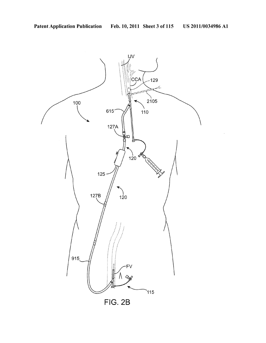 SYSTEMS AND METHODS FOR TREATING A CAROTID ARTERY - diagram, schematic, and image 04
