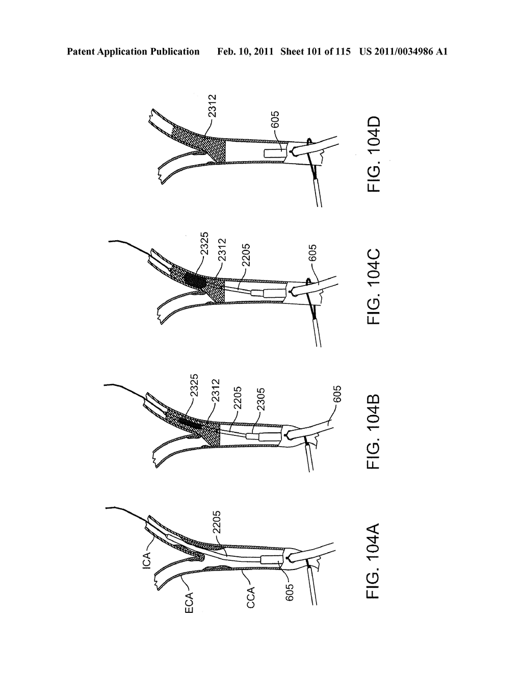 SYSTEMS AND METHODS FOR TREATING A CAROTID ARTERY - diagram, schematic, and image 102