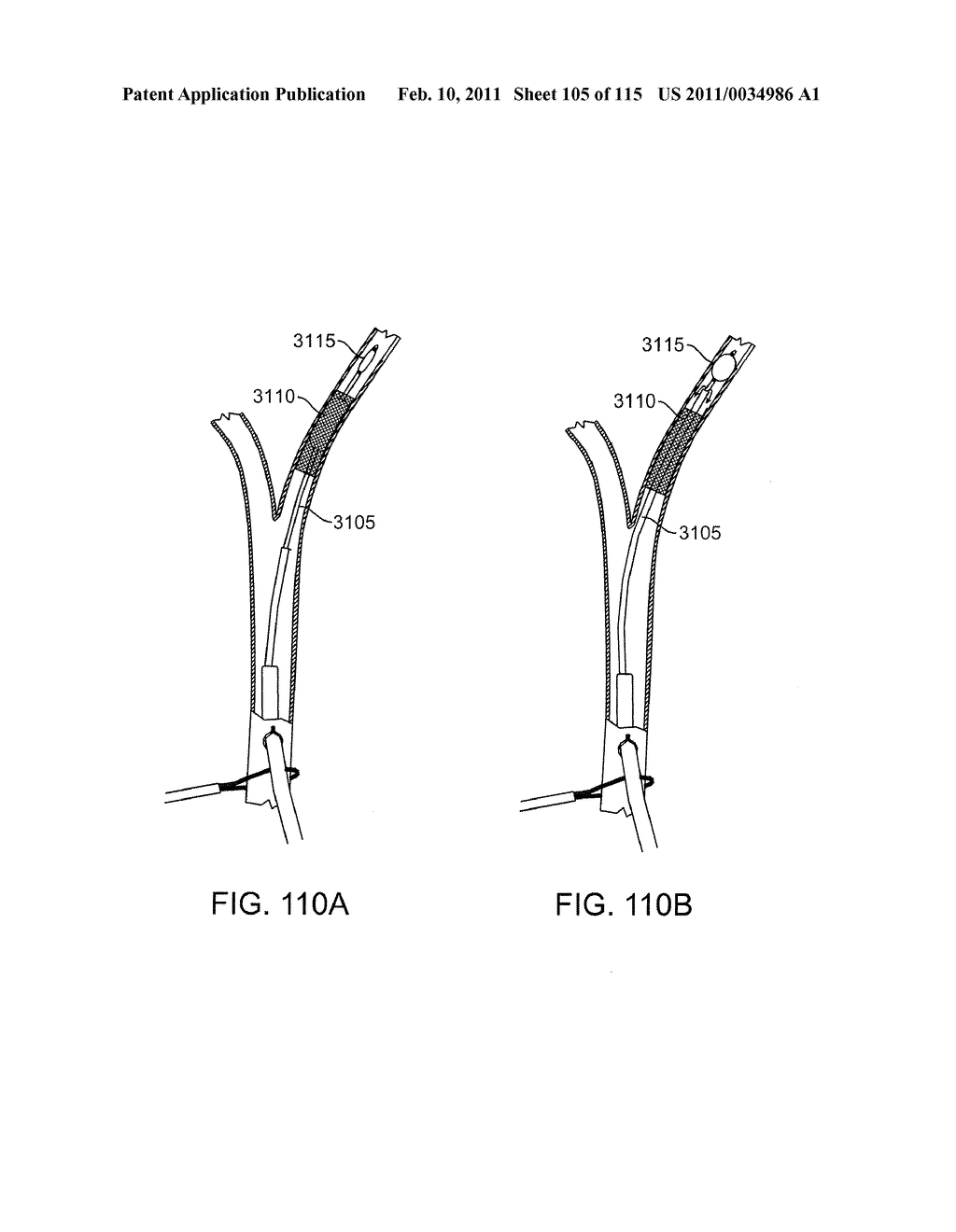 SYSTEMS AND METHODS FOR TREATING A CAROTID ARTERY - diagram, schematic, and image 106