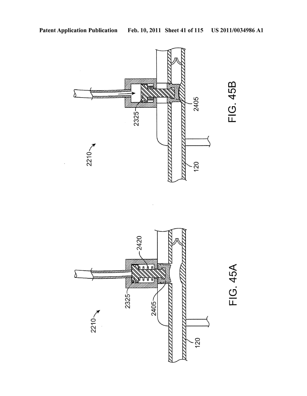 SYSTEMS AND METHODS FOR TREATING A CAROTID ARTERY - diagram, schematic, and image 42