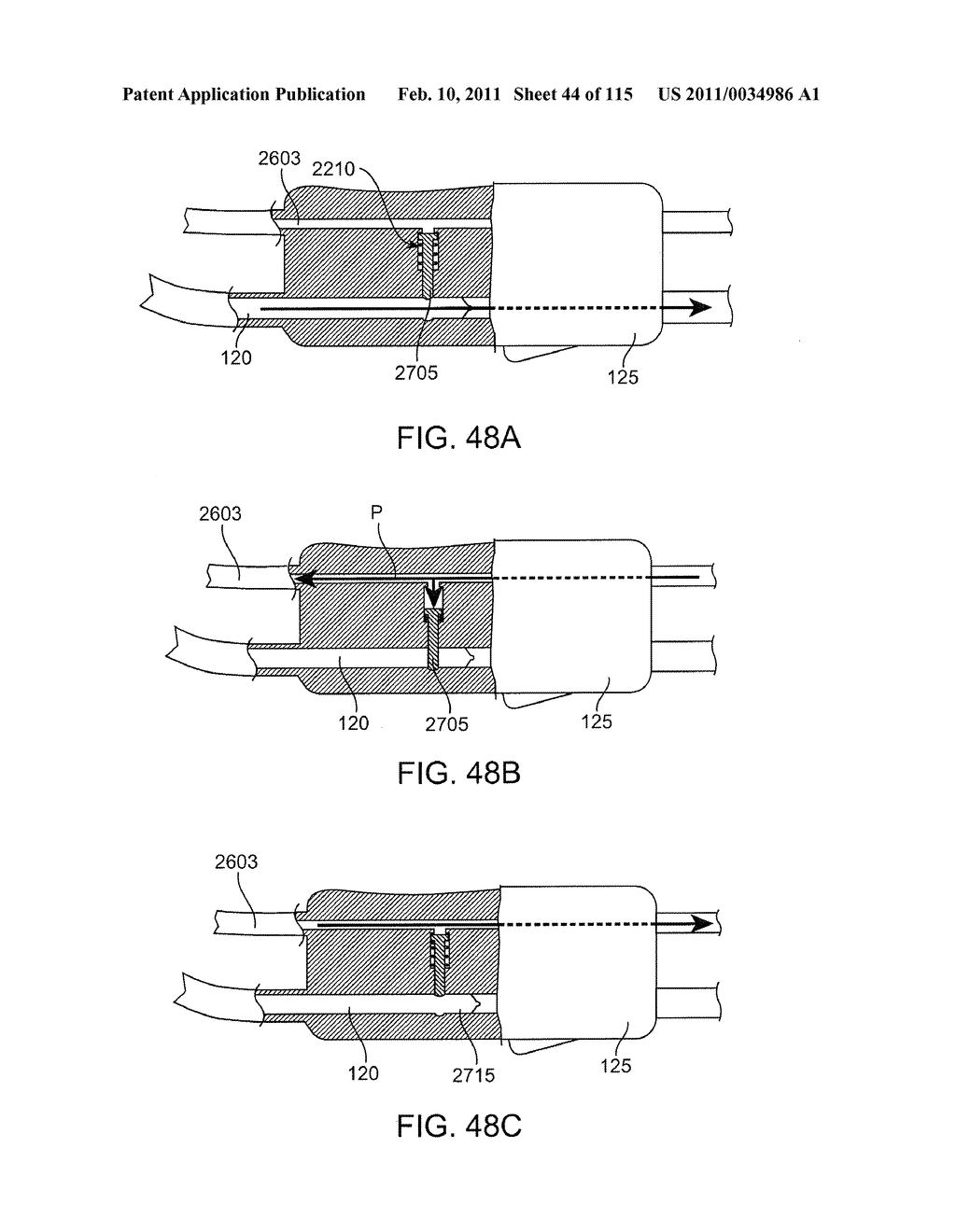 SYSTEMS AND METHODS FOR TREATING A CAROTID ARTERY - diagram, schematic, and image 45