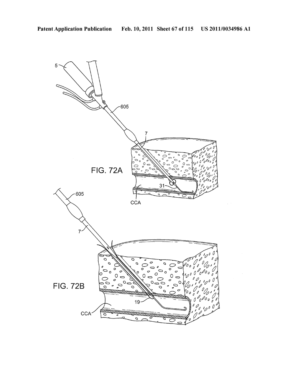 SYSTEMS AND METHODS FOR TREATING A CAROTID ARTERY - diagram, schematic, and image 68