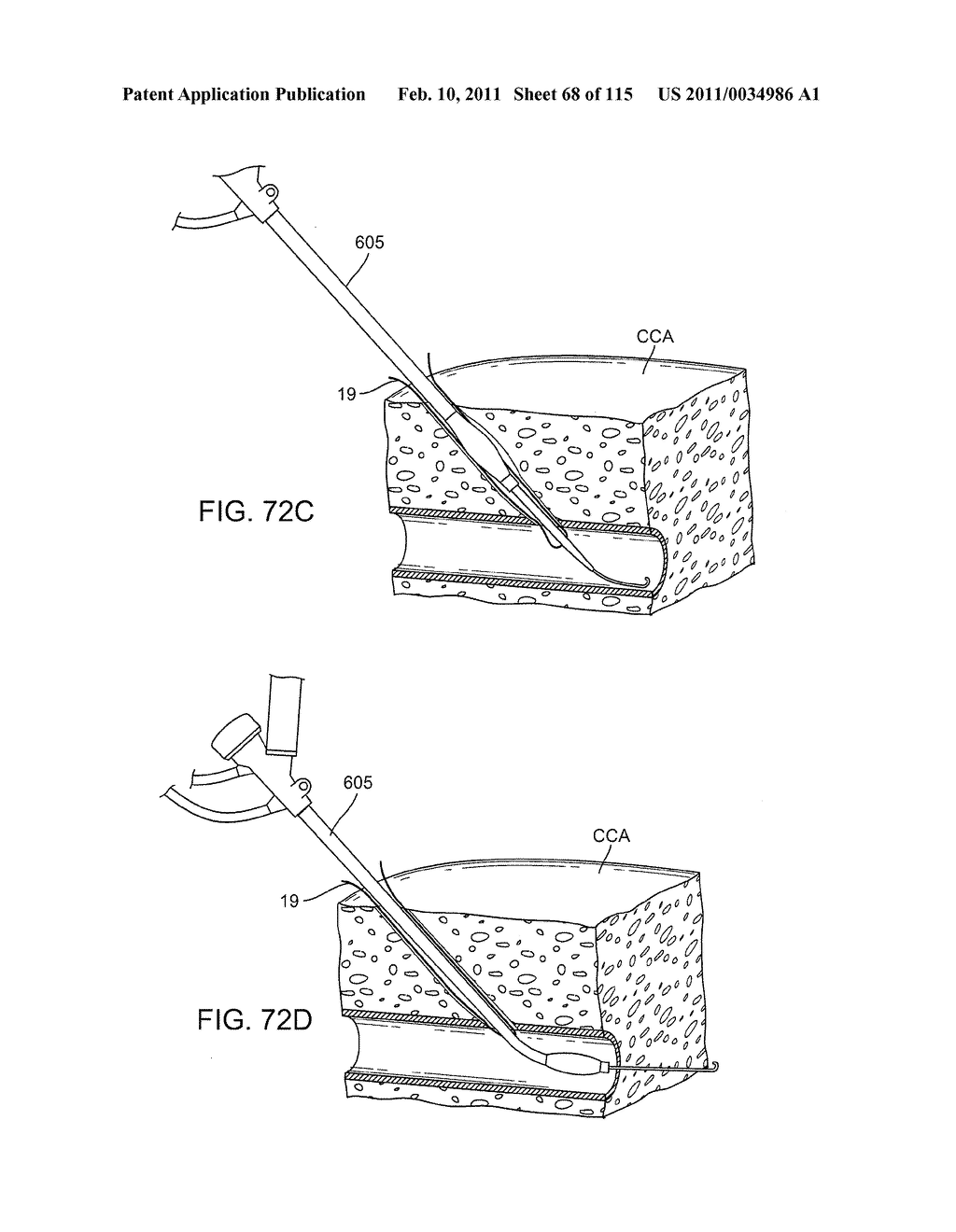 SYSTEMS AND METHODS FOR TREATING A CAROTID ARTERY - diagram, schematic, and image 69