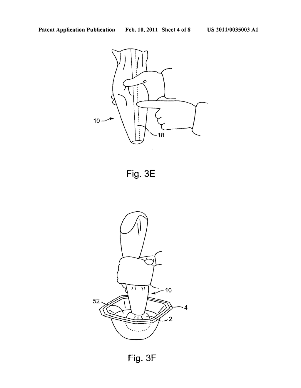 Fail-Safe Silicone Breast Implant Delivery Device - diagram, schematic, and image 05