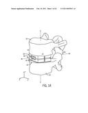 EXPANDABLE INTERVERTEBRAL IMPLANT diagram and image