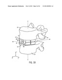 EXPANDABLE INTERVERTEBRAL IMPLANT diagram and image