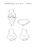 OSTEOCHONDRAL IMPLANT PROCEDURE diagram and image