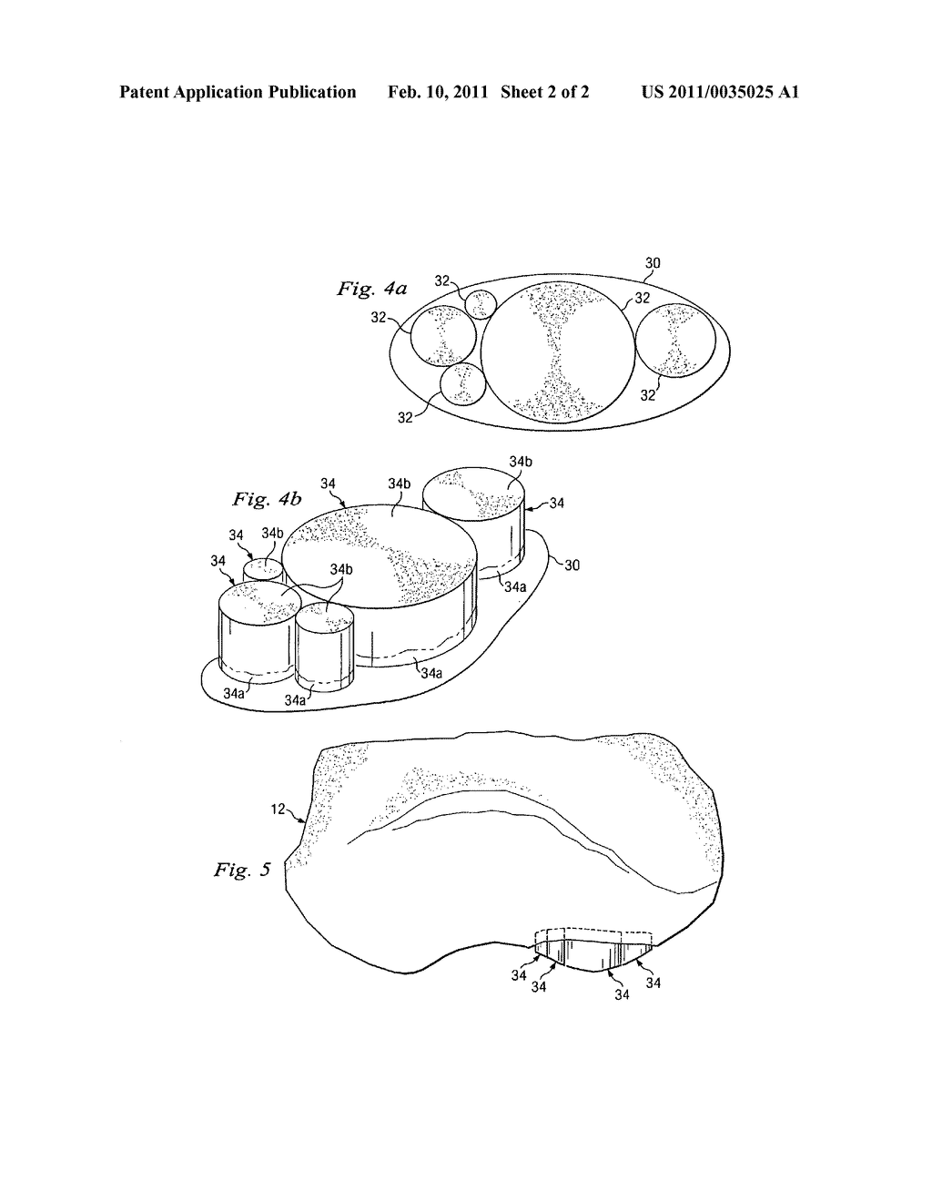 OSTEOCHONDRAL IMPLANT PROCEDURE - diagram, schematic, and image 03